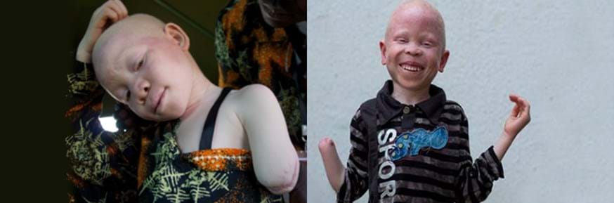 Ten-year-old Mwigulu Matonange's left arm was cut off above the elbow and six-year-old Baraka Cosmas Rusambo lost his right hand in witchcraft-related attacks both in Western Tanzania. © Under the Same Sun, a Canadian NGO that promotes the wellbeing of people with albinism through education and advocacy.